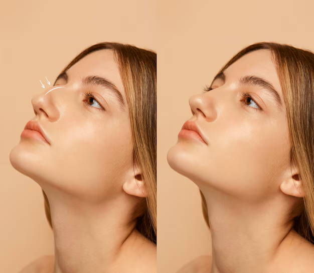 Before and after chin filler results showing improved chin contour and facial profile